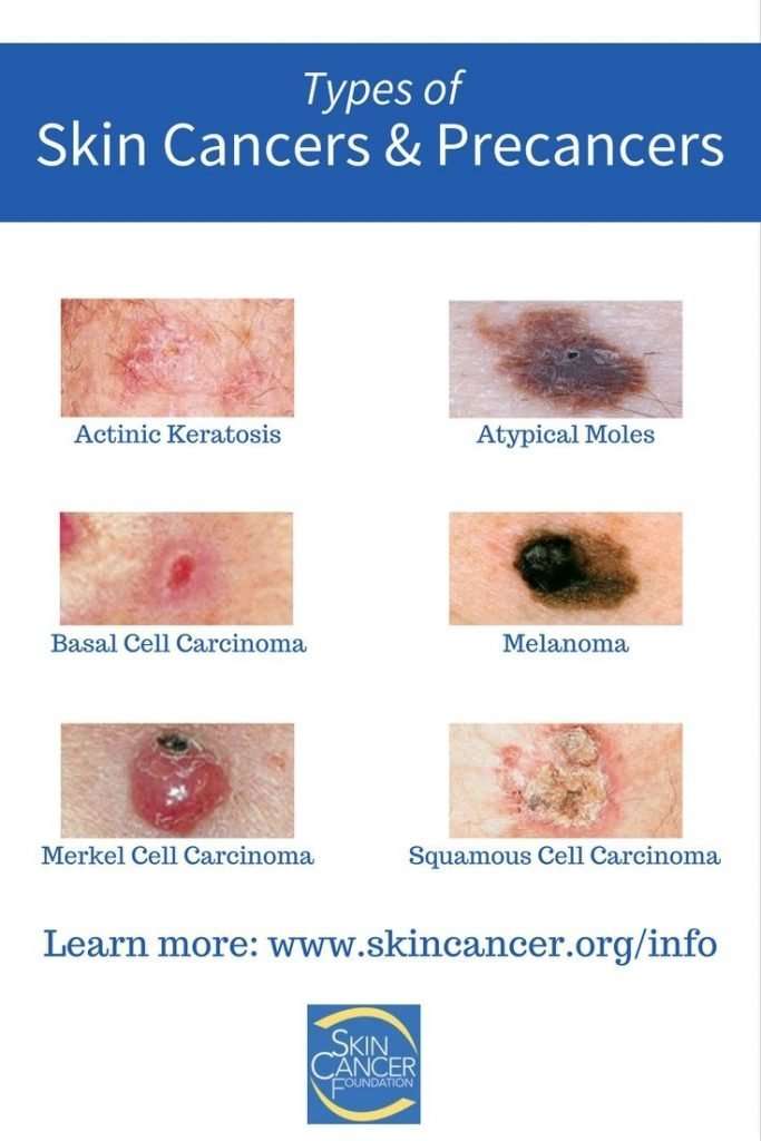 Skin Cancer Pictures 5 Different Types Of Skin Cancer To Know Kulturaupice