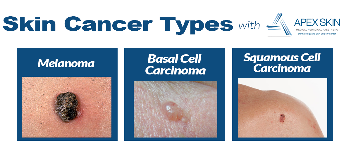 What Is The Most Dangerous Kind Of Skin Cancer - HealthySkinWorld.com